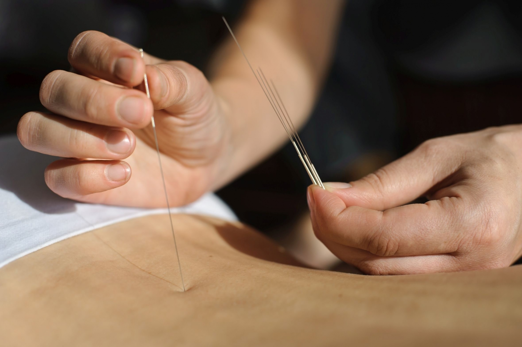 Therapist with one hand holding the needle with the other hand enters their desired point on the patient's back Acupuncture.Chinese medicine treatmen