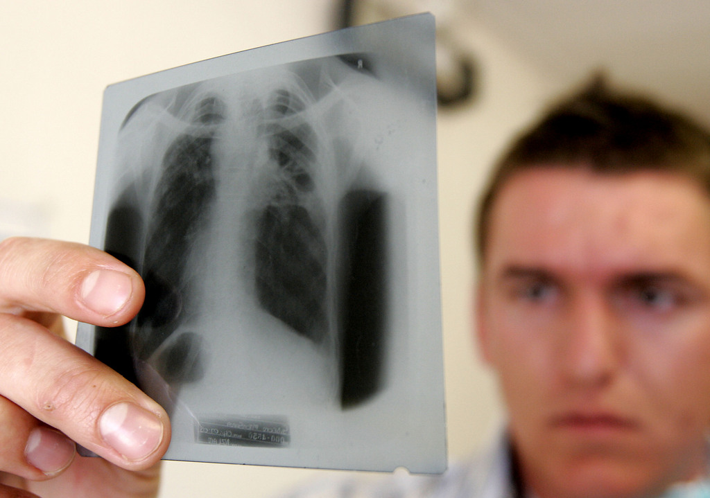 La Suisse est l'un des pays les moins touchés par la tuberculose.